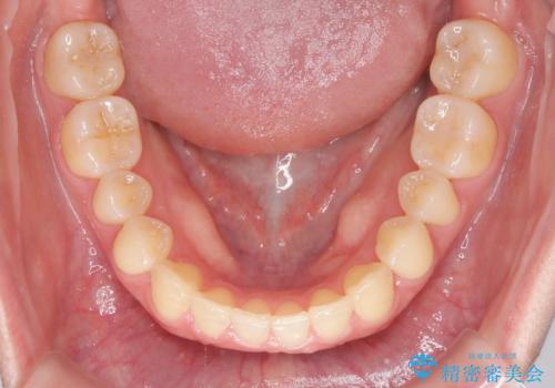 インビザラインとワイヤー矯正の併用で綺麗な歯並びに!の治療後