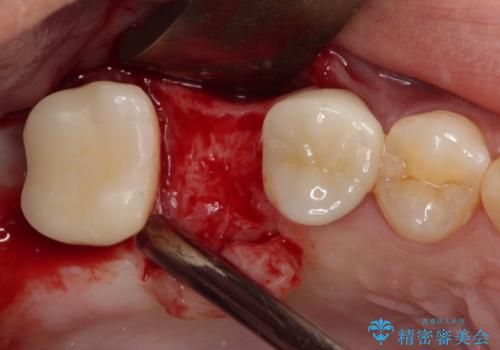 壊れやすいブリッジ インプラント治療で安定した咬み合わせにの治療前