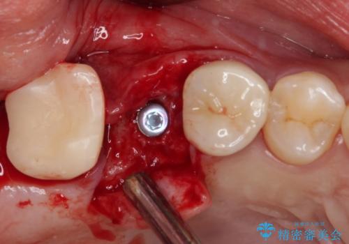壊れやすいブリッジ インプラント治療で安定した咬み合わせにの治療中
