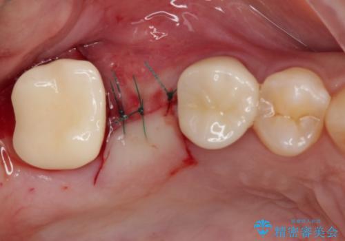 壊れやすいブリッジ インプラント治療で安定した咬み合わせにの治療後