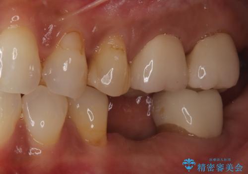 歯の破折 食べる喜びが蘇るインプラント治療の治療前