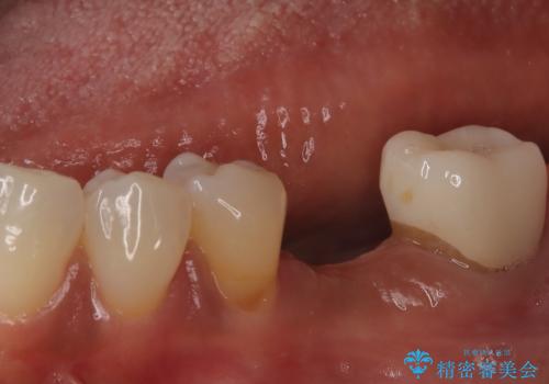 歯の破折 食べる喜びが蘇るインプラント治療の症例 治療前
