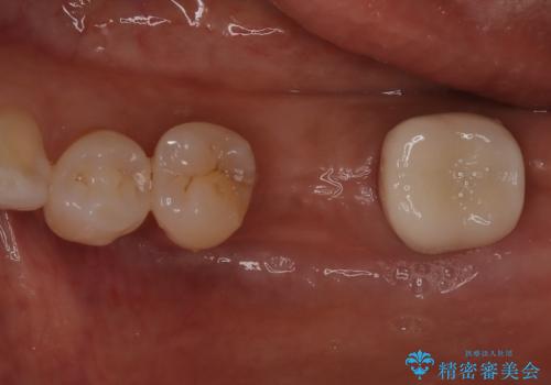 歯の破折　食べる喜びが蘇るインプラント治療の治療前