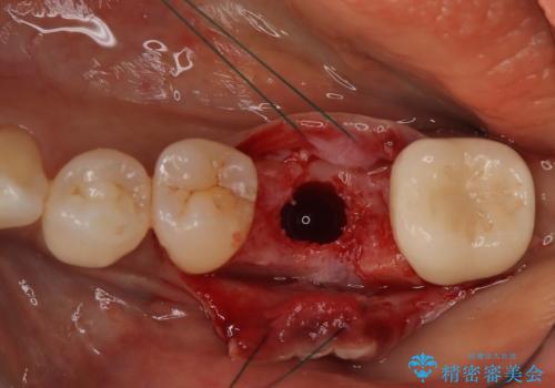 歯の破折　食べる喜びが蘇るインプラント治療の治療中