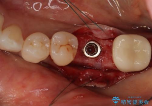歯の破折 食べる喜びが蘇るインプラント治療の治療中