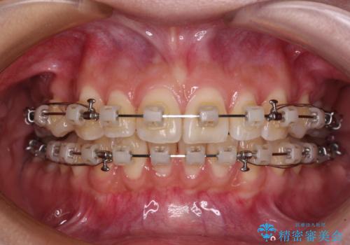飛び出した前歯を引っ込めたい ワイヤー装置での抜歯矯正の治療中