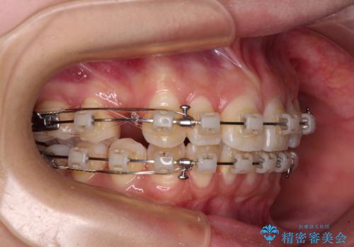 飛び出した前歯を引っ込めたい ワイヤー装置での抜歯矯正の治療中