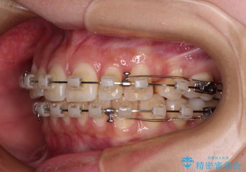 飛び出した前歯を引っ込めたい ワイヤー装置での抜歯矯正の治療中