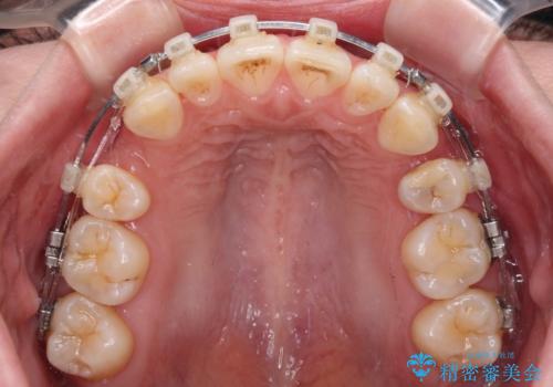 飛び出した前歯を引っ込めたい ワイヤー装置での抜歯矯正の治療中