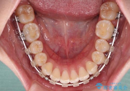 飛び出した前歯を引っ込めたい ワイヤー装置での抜歯矯正の治療中