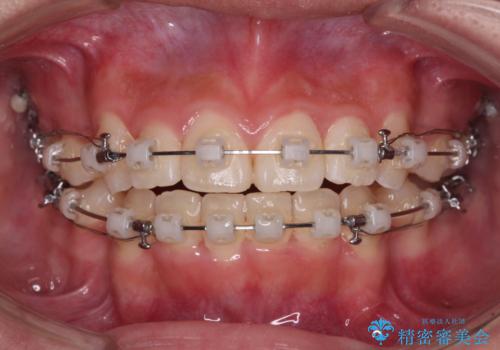 上顎骨幅が狭い　急速拡大装置を併用した抜歯矯正の治療中