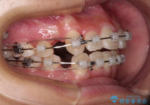 上顎骨幅が狭い 急速拡大装置を併用した抜歯矯正の治療中