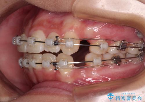 上顎骨幅が狭い 急速拡大装置を併用した抜歯矯正の治療中