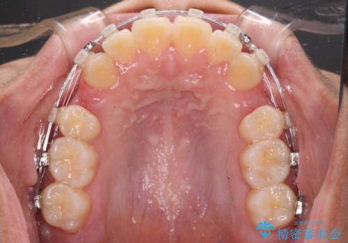 上顎骨幅が狭い 急速拡大装置を併用した抜歯矯正の治療中