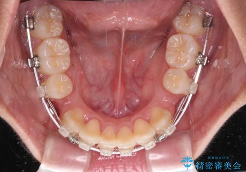 上顎骨幅が狭い　急速拡大装置を併用した抜歯矯正の治療中