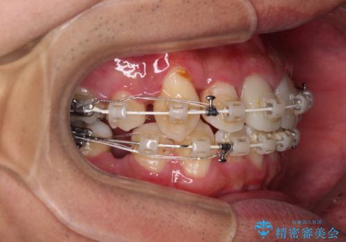 デコボコと変色した前歯 抜歯矯正と審美歯科治療の治療中