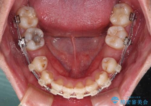 デコボコと変色した前歯 抜歯矯正と審美歯科治療の治療中