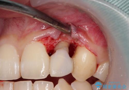 抜歯と言われた前歯　牽引してセラミッククラウンで保存するの治療中