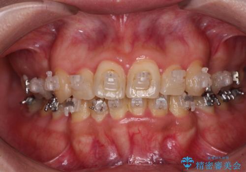 治療途中で帰国 装置をつけた状態を継続して矯正治療の治療前