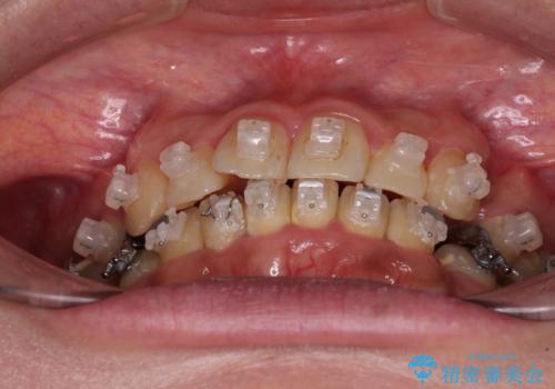 治療途中で帰国 装置をつけた状態を継続して矯正治療の治療前