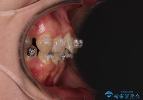 治療途中で帰国 装置をつけた状態を継続して矯正治療の治療前