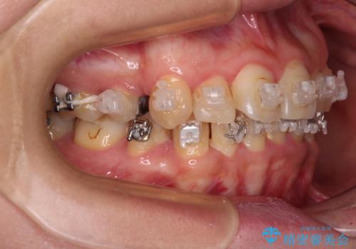 治療途中で帰国 装置をつけた状態を継続して矯正治療の治療前