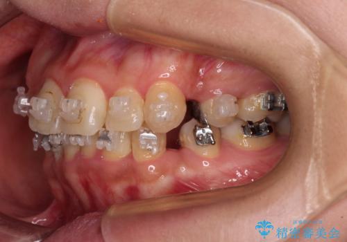 治療途中で帰国 装置をつけた状態を継続して矯正治療の治療前