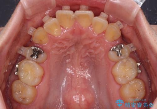 治療途中で帰国 装置をつけた状態を継続して矯正治療の治療前