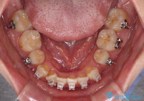 治療途中で帰国 装置をつけた状態を継続して矯正治療の治療前