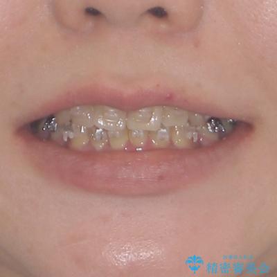 治療途中で帰国 装置をつけた状態を継続して矯正治療の治療前(顔貌)