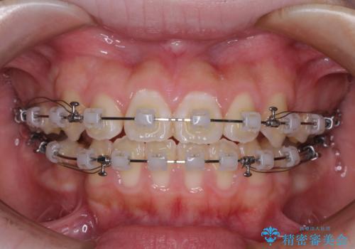 舌突出癖で出っ歯と開咬に 舌のトレーニングを行いながら抜歯矯正 の治療中