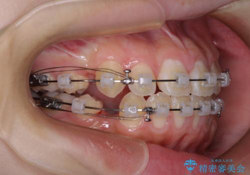 舌突出癖で出っ歯と開咬に 舌のトレーニングを行いながら抜歯矯正 の治療中