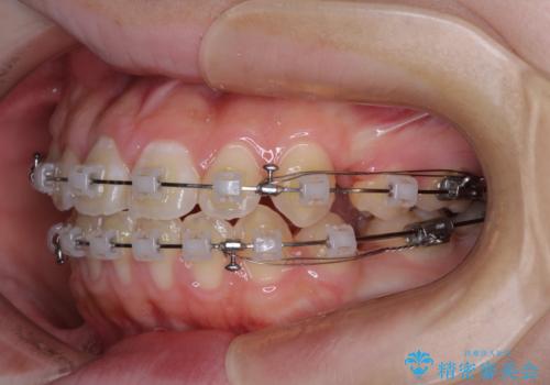 舌突出癖で出っ歯と開咬に 舌のトレーニングを行いながら抜歯矯正 の治療中