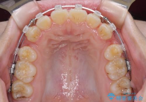 舌突出癖で出っ歯と開咬に 舌のトレーニングを行いながら抜歯矯正 の治療中