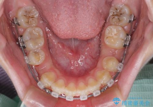 舌突出癖で出っ歯と開咬に　舌のトレーニングを行いながら抜歯矯正　の治療中