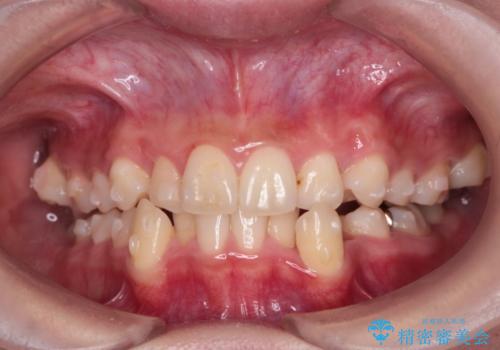 【抜歯矯正】犬歯抜歯による矯正。八重歯を治したい。の治療中