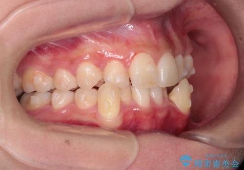 【抜歯矯正】犬歯抜歯による矯正。八重歯を治したい。の治療中