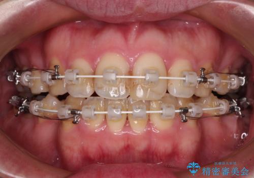 しゃくれて口が閉じられない ワイヤー装置での抜歯矯正の治療中
