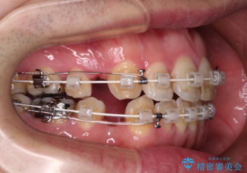 しゃくれて口が閉じられない ワイヤー装置での抜歯矯正の治療中