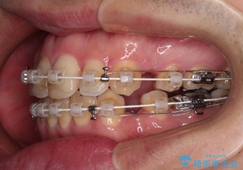 しゃくれて口が閉じられない ワイヤー装置での抜歯矯正の治療中