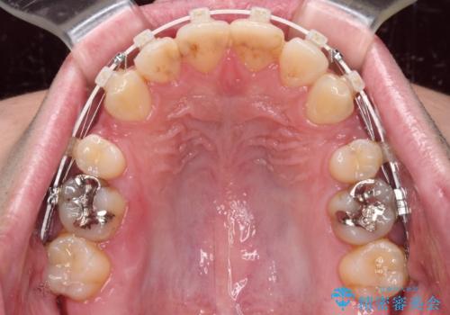 しゃくれて口が閉じられない ワイヤー装置での抜歯矯正の治療中