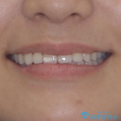 咬み合わせの乱れを改善 ワイヤー装置で楽々矯正治療の治療後(顔貌)