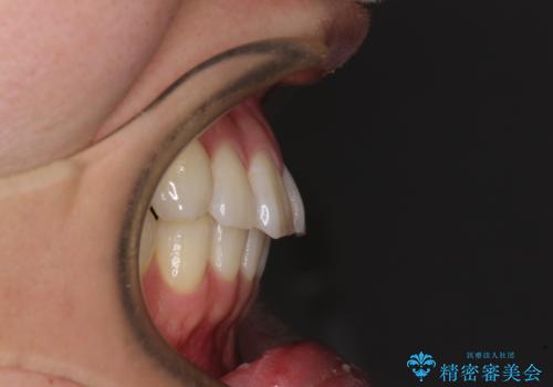 【モニター】動きにくい歯と乱れた咬合平面　アンカースクリューで咬合改善の治療前