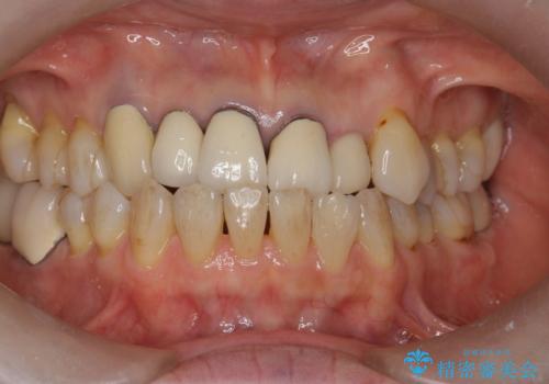 前歯のセラミック 神経の再治療からの治療前