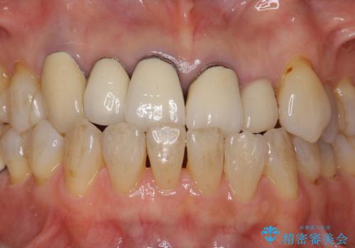 前歯のセラミック 神経の再治療から