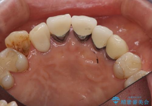 前歯のセラミック 神経の再治療からの治療前