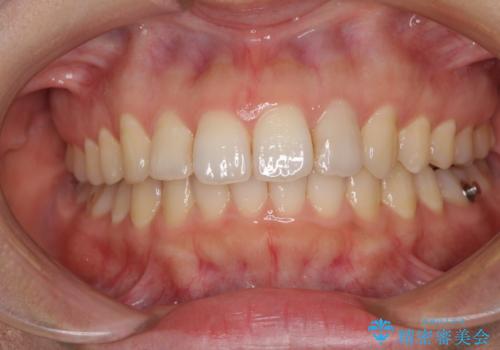 インビザライン矯正で前歯のデコボコを改善の治療中