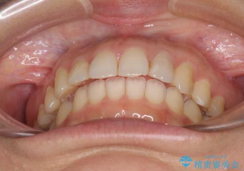 インビザライン矯正で前歯のデコボコを改善の治療中