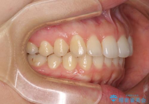 インビザライン矯正で前歯のデコボコを改善の治療中