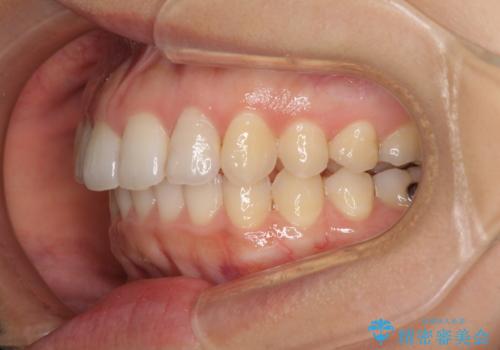 インビザライン矯正で前歯のデコボコを改善の治療中